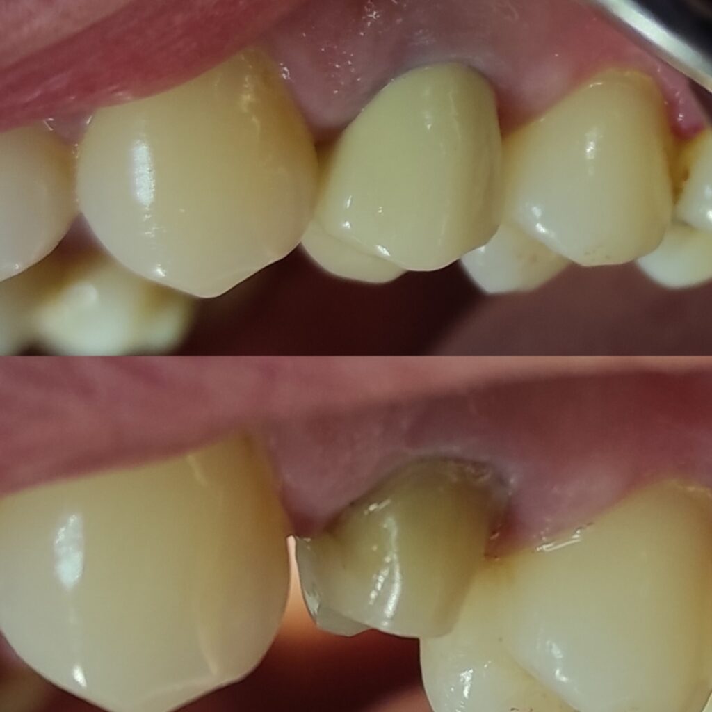 Фото работы 1 по протезированию зубов