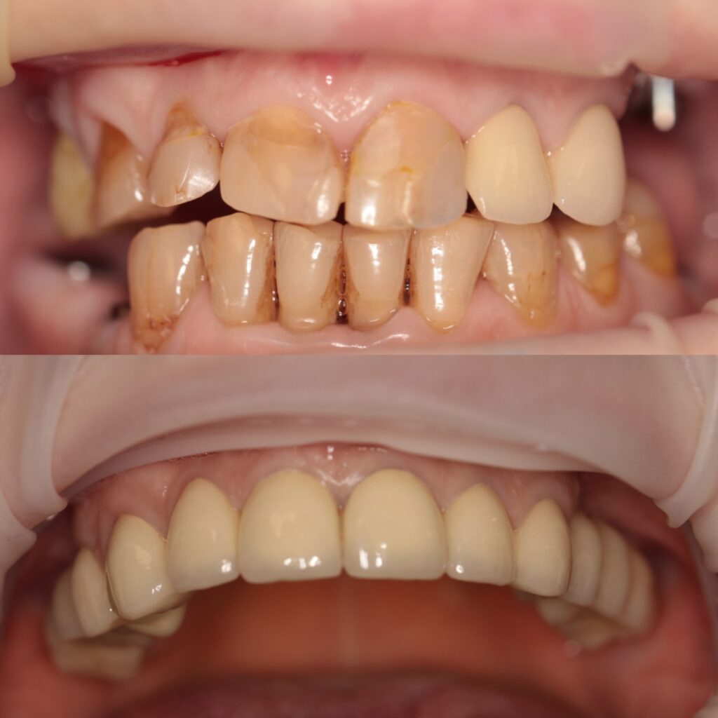 Фото работы 2 по протезированию зубов