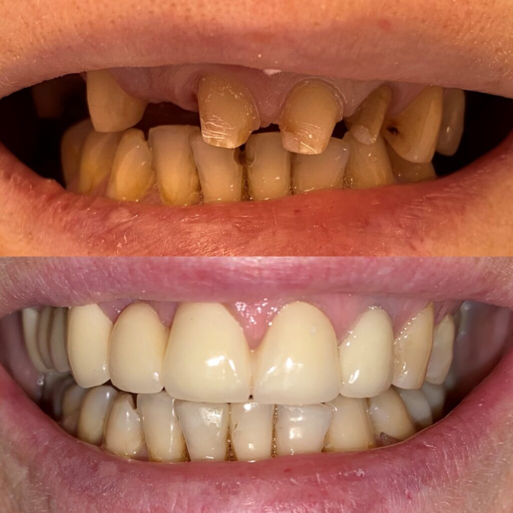 Фото работы 3 по протезированию зубов