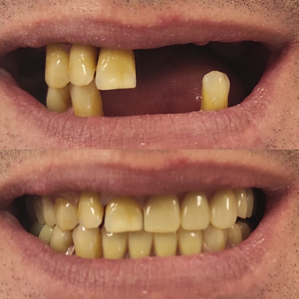 Фото работы 4 по протезированию зубов
