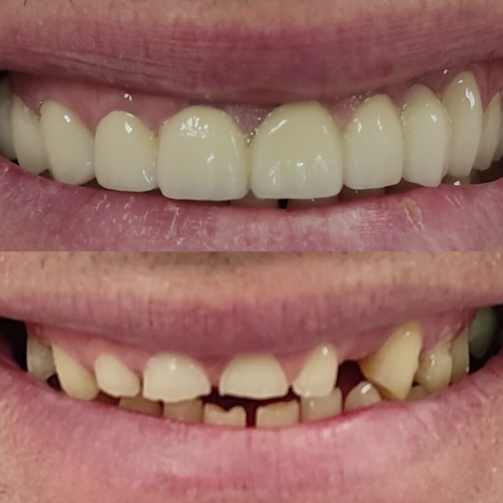 Фото работы 5 по протезированию зубов