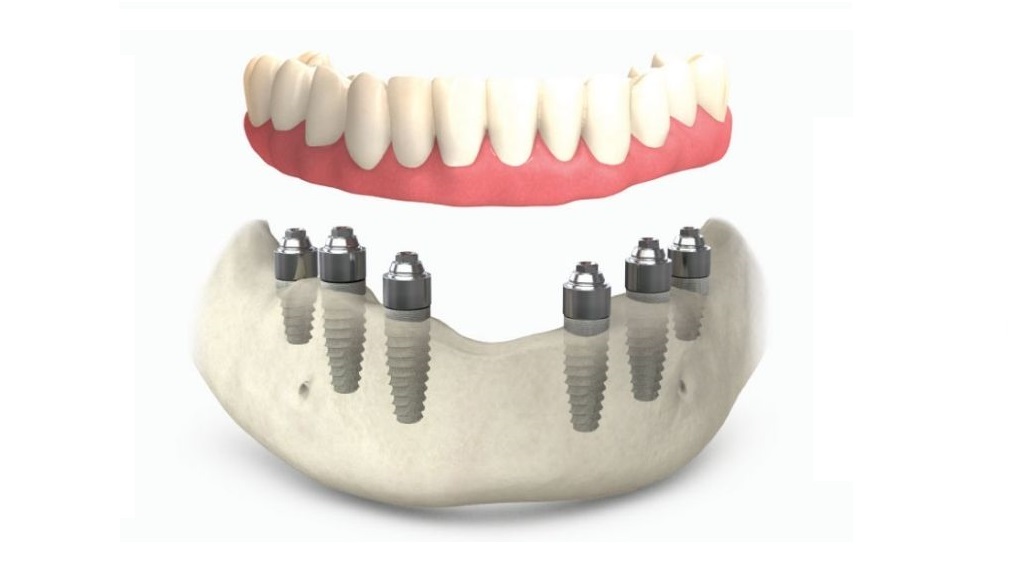 Комбинированный способ имплантации зубов