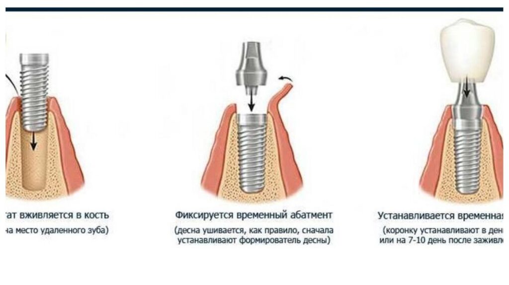 Имплантация зубов в один этап