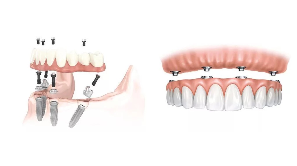 Имплантация зубов методом ALL-ON-4