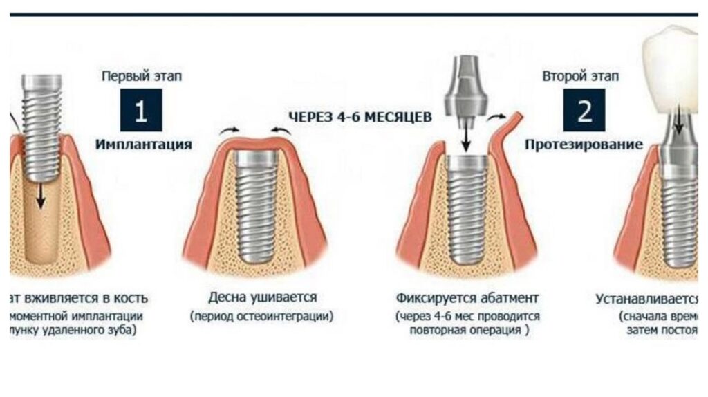 Классический способ имплантации зубов