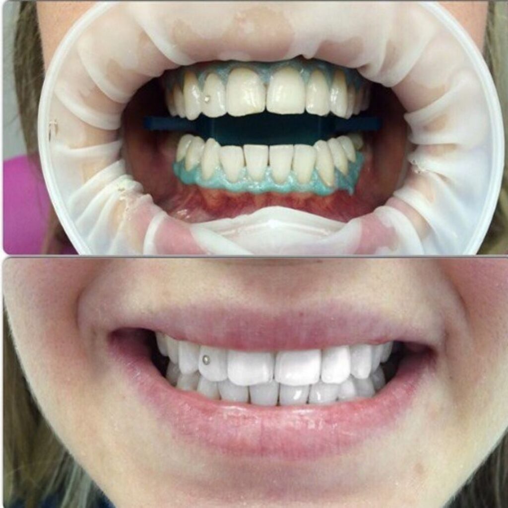 Работа 1 - Отбеливание зубов