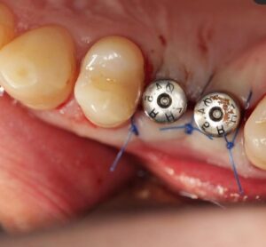 Работа 4 Гадисова Р.Ф. по имплантации зубов