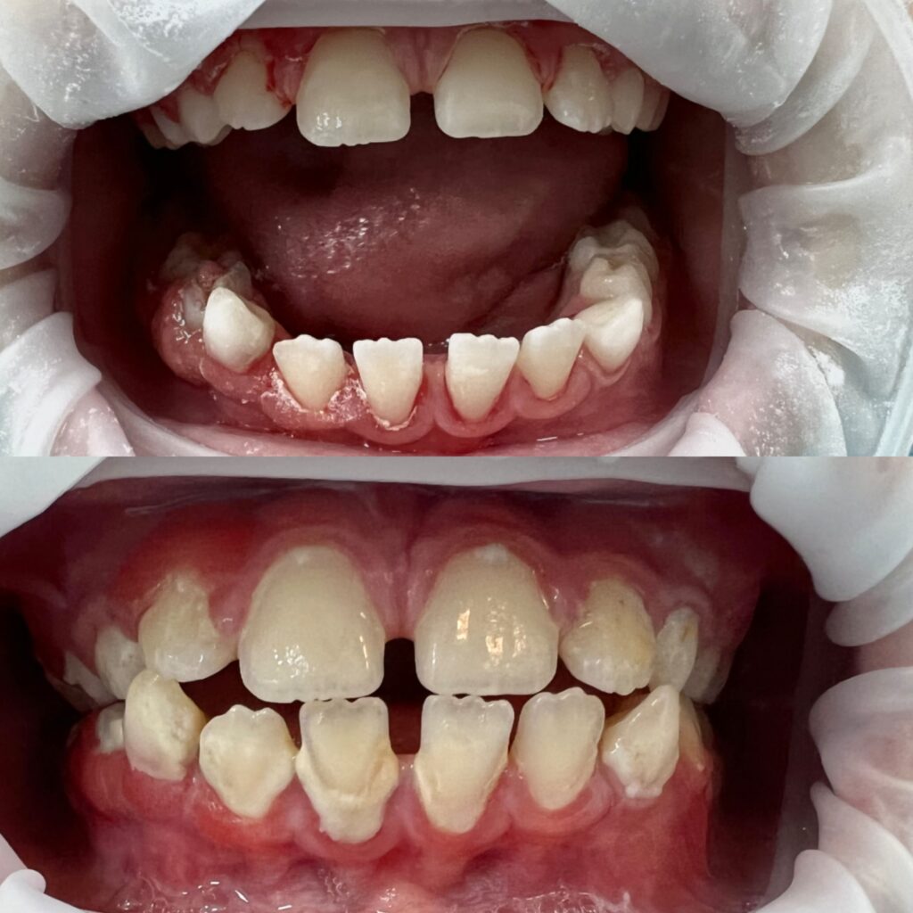 Работа Гадисовой Р.Р. - Чистка молочных зубов