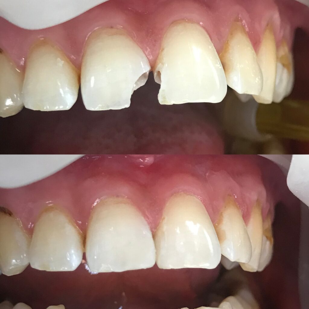 Работа Гадисовой Р.Р. - Художественная реставрация зубов