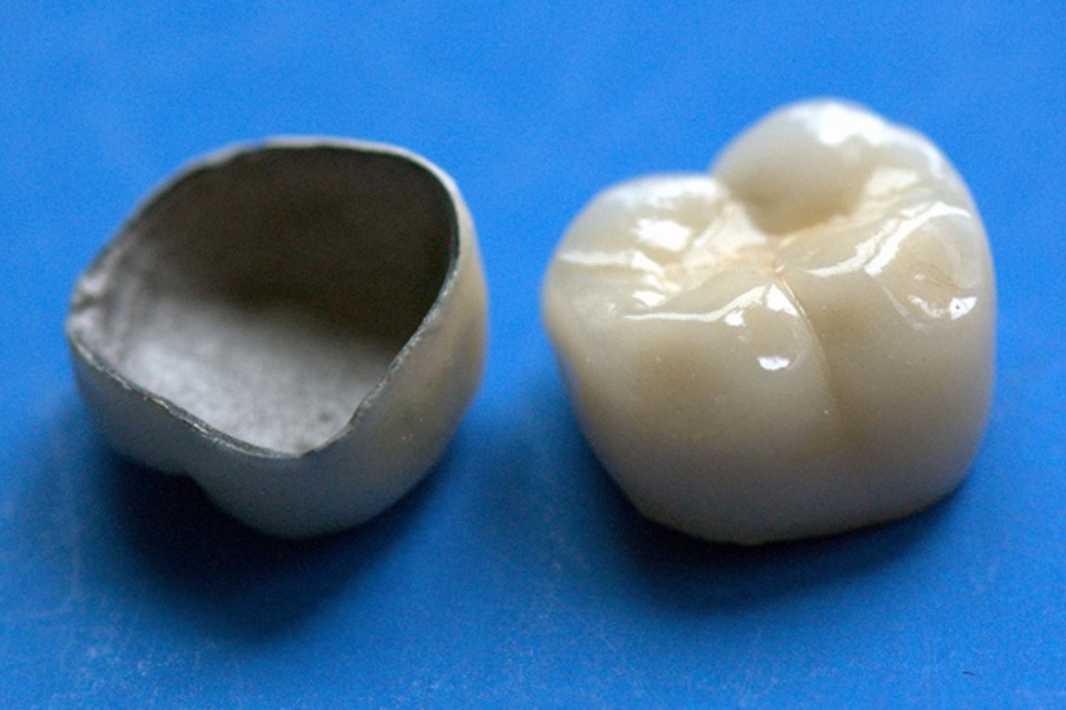 Установка металлокерамических зубных коронок
