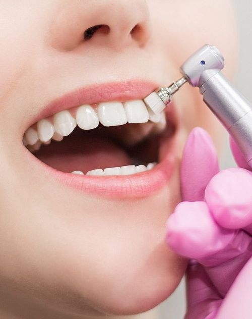 Акция - Профессиональная чистка зубов в 4 этапа