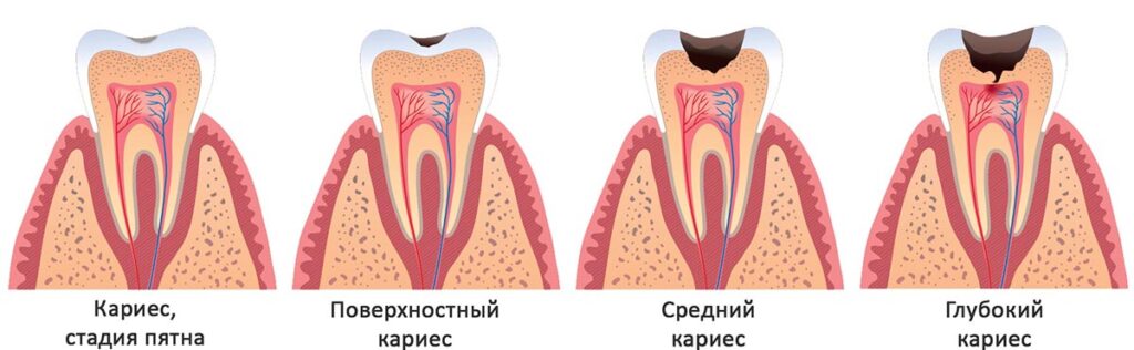 Стадии кариесы зубов