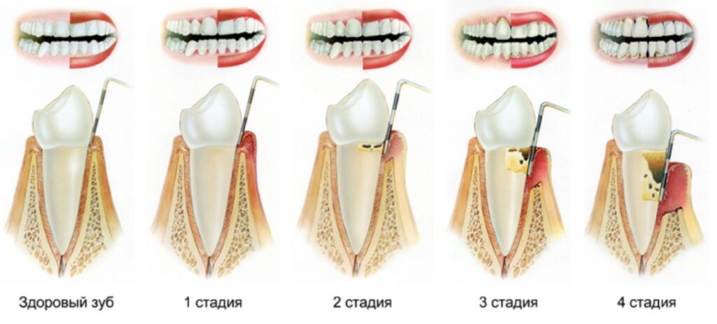 Рис. 1. Стадии развития заболевания пародонтита зубов